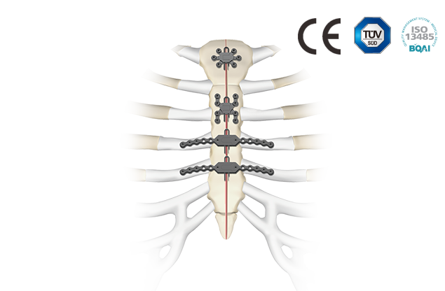 胸肋骨固定系统