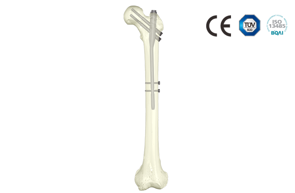 股骨近端三型 髓内钉