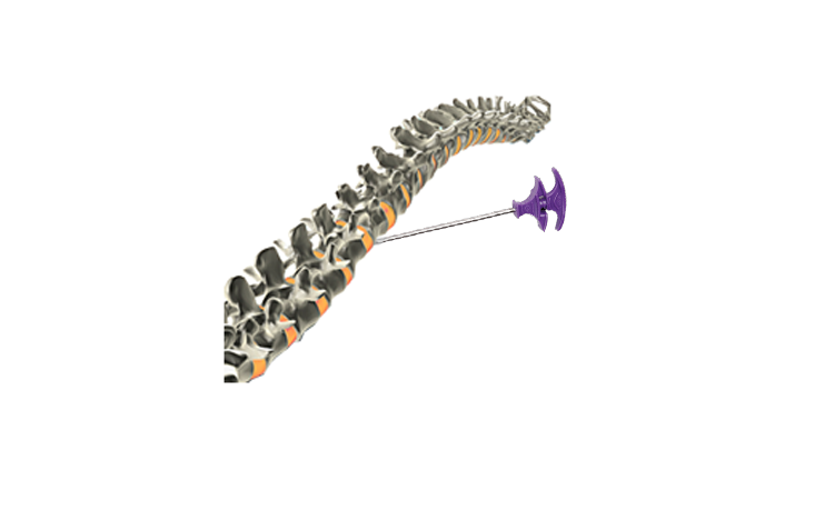 新的脊柱微創術式- 經皮椎體成形術